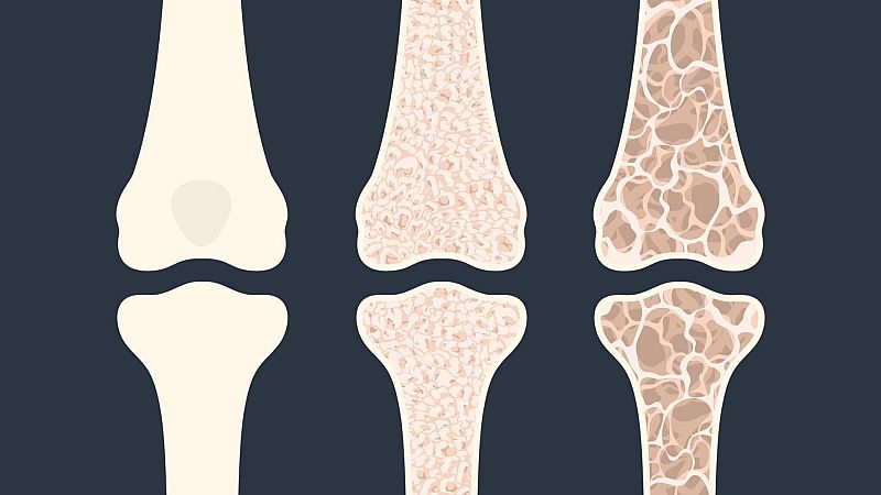 Ilustración médica que compara una articulación sana con otra afectada por osteoporosis avanzada, mostrando la pérdida de masa ósea.