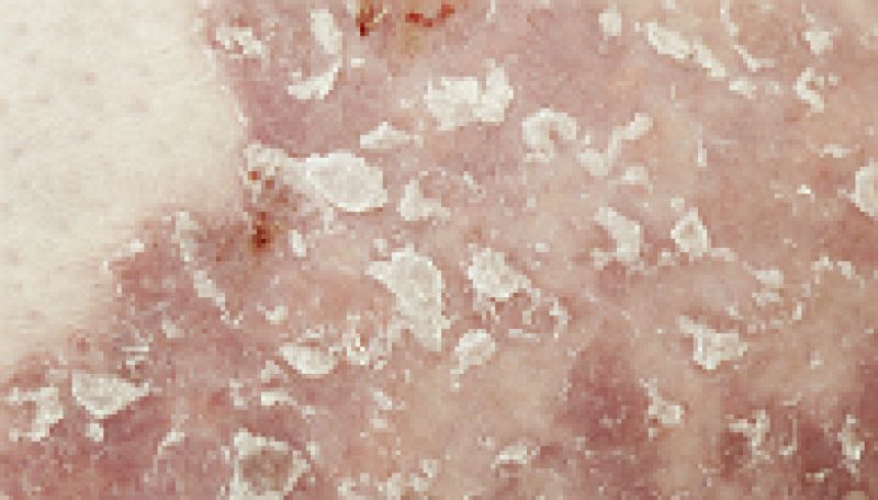 A su salud - Barómetro de la psoriasis - 04/03/15