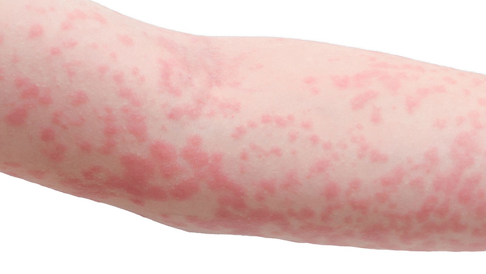 Farmacia Abierta - El sarampión - 07/11/16 - Escuchar ahora