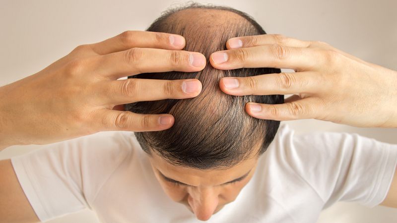 El canto del grillo - Injerto capilar: turismo médico a Turquía - Escuchar ahora