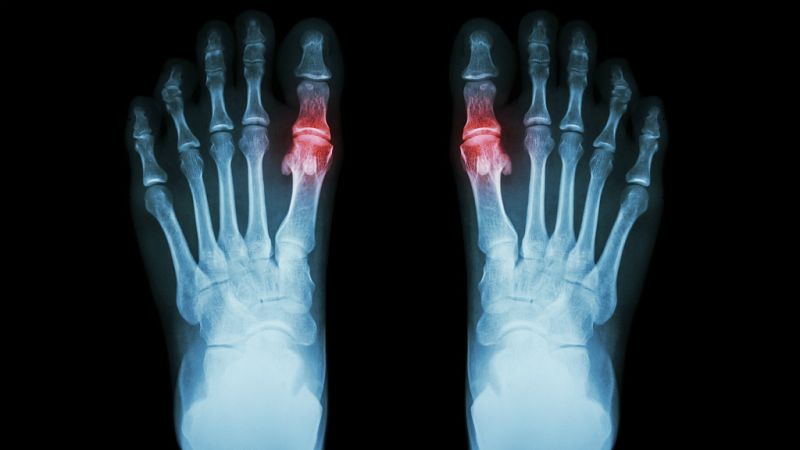 España vuelta y vuelta - Hablamos del ácido úrico y de la enfermedad de la gota - 06/07/17