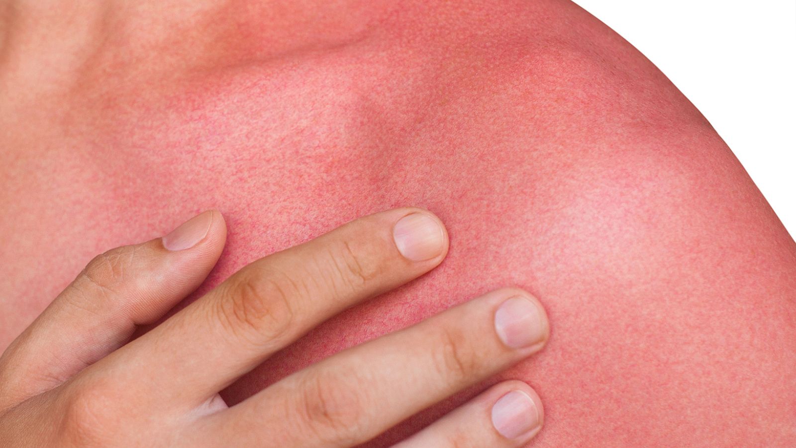 Farmacia Abierta - Quemaduras - 14/05/18 - Escuchar ahora