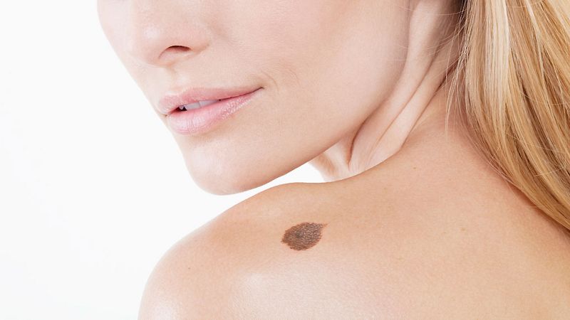 El canto del grillo - La prevención del melanoma - Escuchar ahora