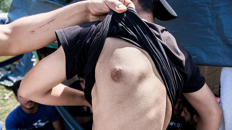 Algunos refugiados y migrantes muestran signos de la violencia contra ellos de los guardias croatas