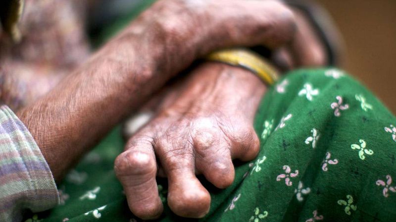 Memoria de delfín - Lepra: del aislamiento al diagnóstico precoz - 26/01/19 - escuchar ahora