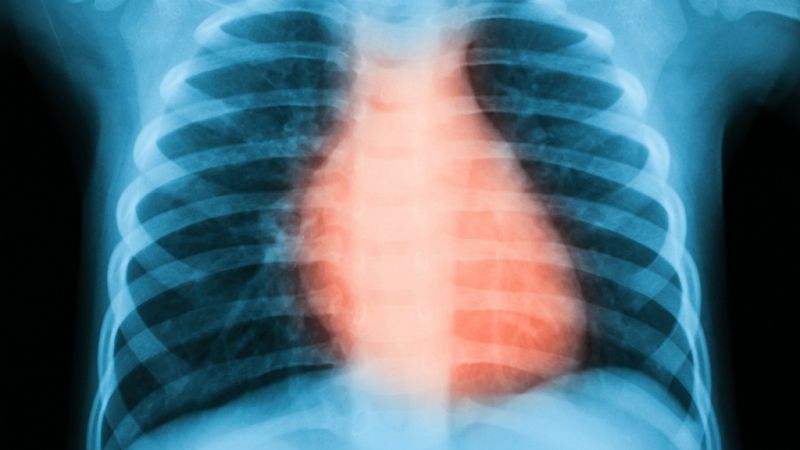 A su salud - Enfermedad cardiovascular: primera causa de muerte en España - 13/02/19