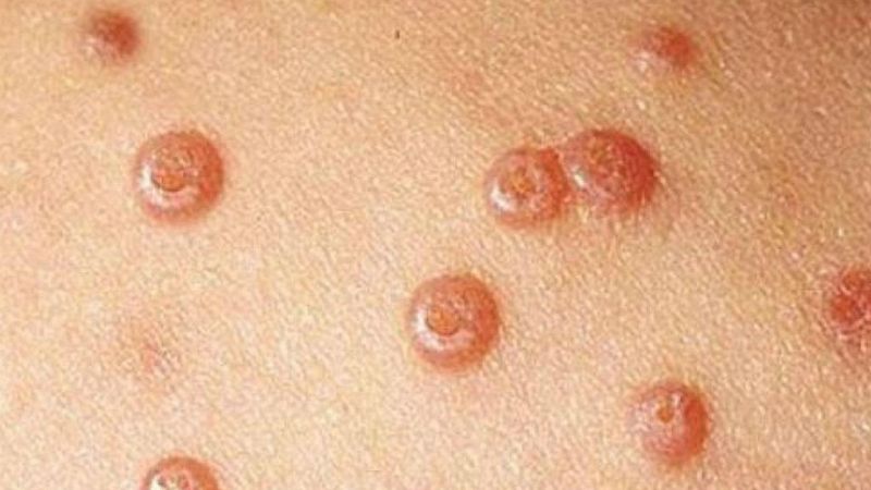 Las mañanas de RNE con Íñigo Alfonso - La importancia de la vacunación para prevenir el VPH - Escuchar ahora