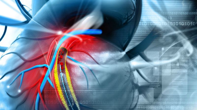 14 horas - ¿Qué es un stent? Ahora Casillas lleva uno en el corazón
