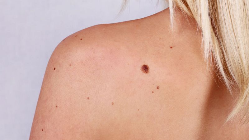 Boletines RNE - ¿Cómo prevenir el melanoma?