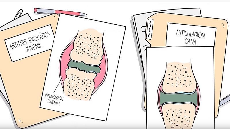 A su salud - Artritis Idiopática Juvenil - 29/11/19 - Escuchar ahora