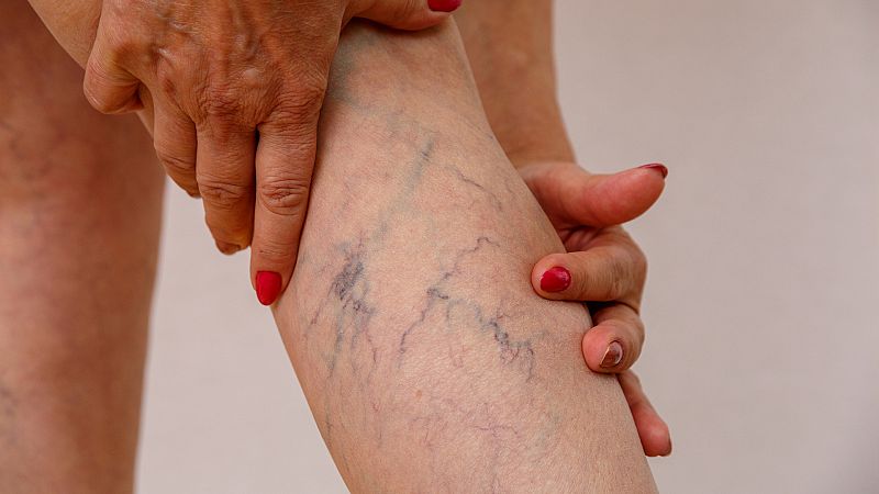 Enfermera saturada - Varices - Escuchar ahora