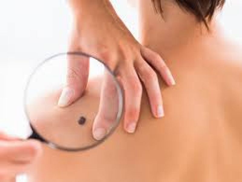 Ojo con el melanoma - 23/05/22 - Escuchar ahora