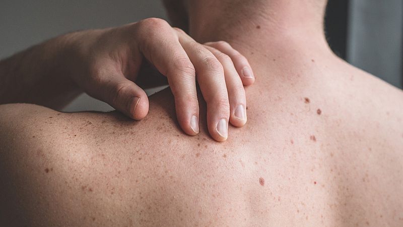 Más cerca - "La autoexploración de la piel ha de hacerse una vez al mes" - Escuchar ahora