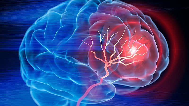 Cuaderno mayor - Cada seis minutos se produce un caso de ictus en España - 27/10/22 - Escuchar ahora