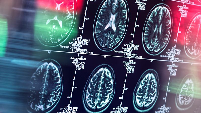 El gallo que no cesa - Rock duro para reactivar el cerebro de pacientes en coma - Escuchar ahora