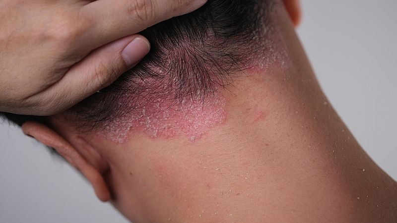 Con bata blanca - Cuando la piel nos alerta del riesgo de infarto e ictus - 27/10/23