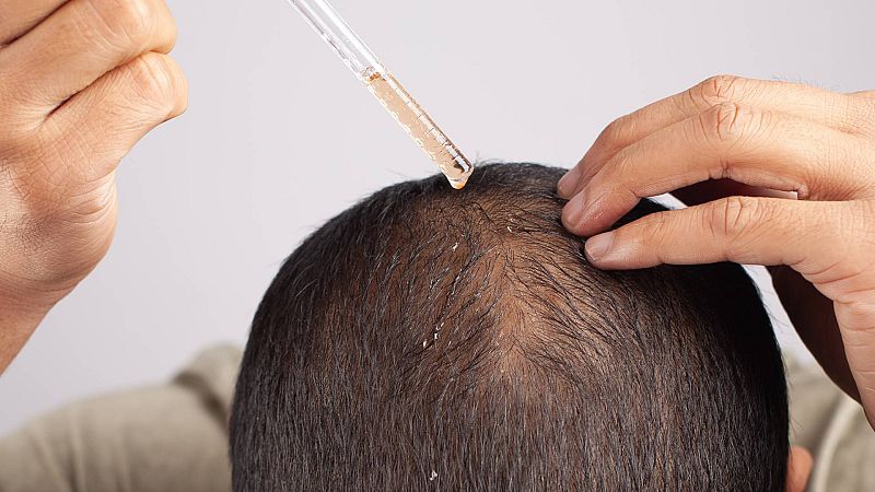 Con bata blanca - España, el segundo país del mundo con más calvos - 15/12/2023