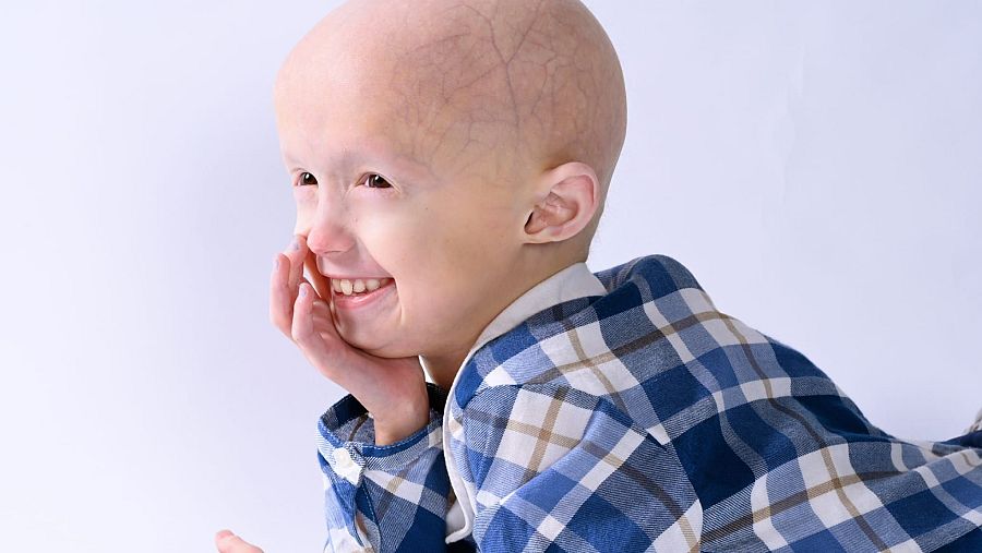 Una niña sonriente, Alexandra Peraut, con signos de progeria, como la falta de cabello y venas visibles, posa con una camisa a cuadros sobre un fondo blanco.