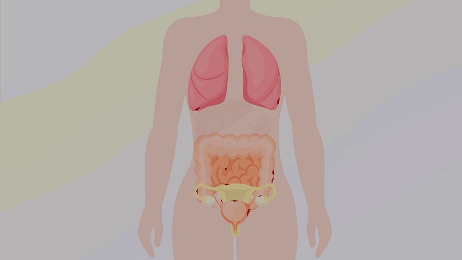 Ilustración anatómica que representa el cuerpo femenino frontalmente, mostrando los órganos internos como pulmones, intestinos y útero con ovarios, con focos de endometriosis representados como manchas rojas.