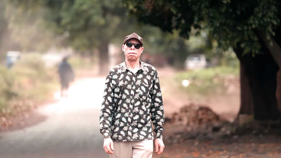 Lovokatus es albino en África, y paciente del Doctor Cavadas