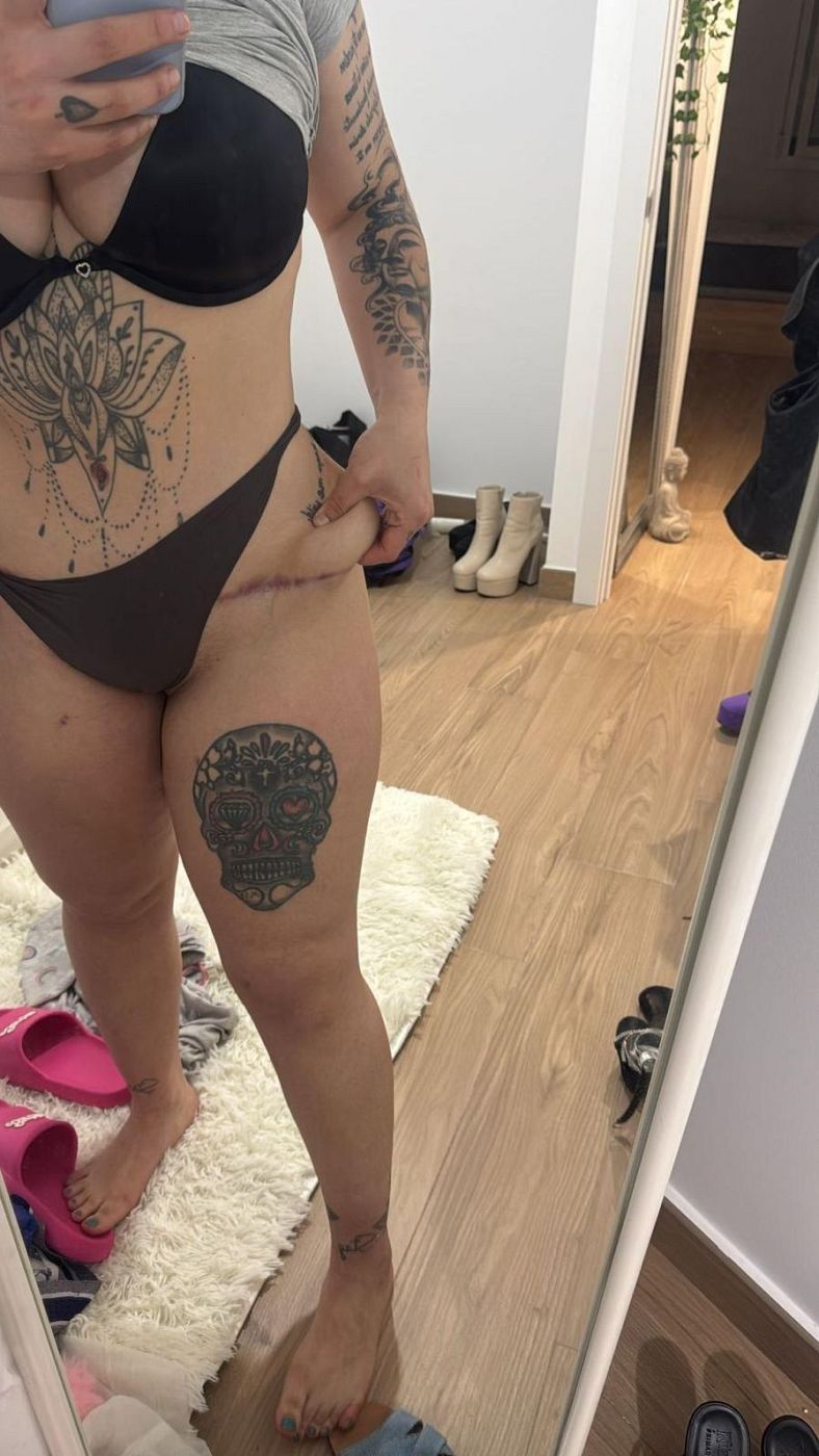 Nerea Irby se hizo en Turquía una lipotransferencia de abdomen a glúteos