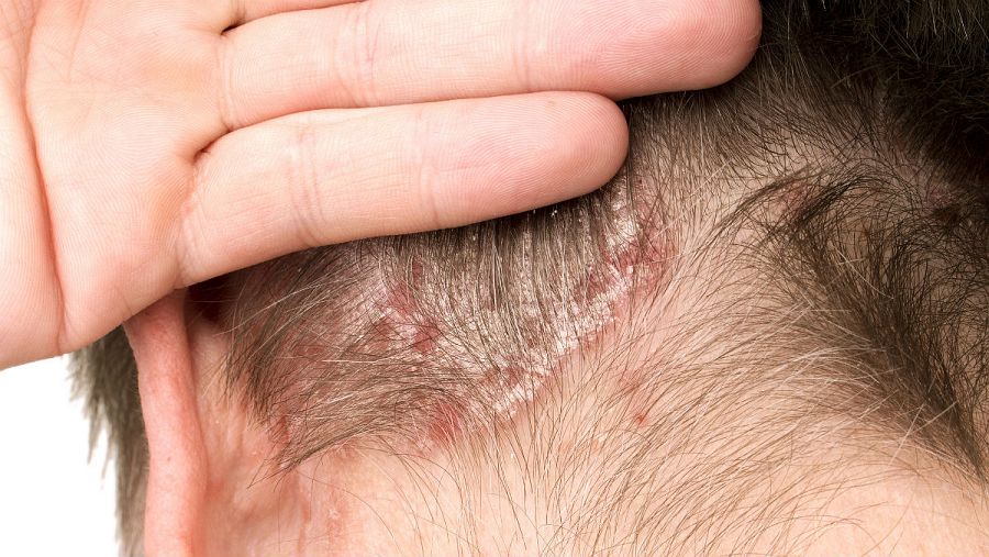 La aparición de lesiones con escamas es una característica de la psoriasis.