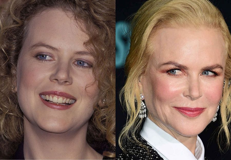 Antes y después de Nicole Kidman
