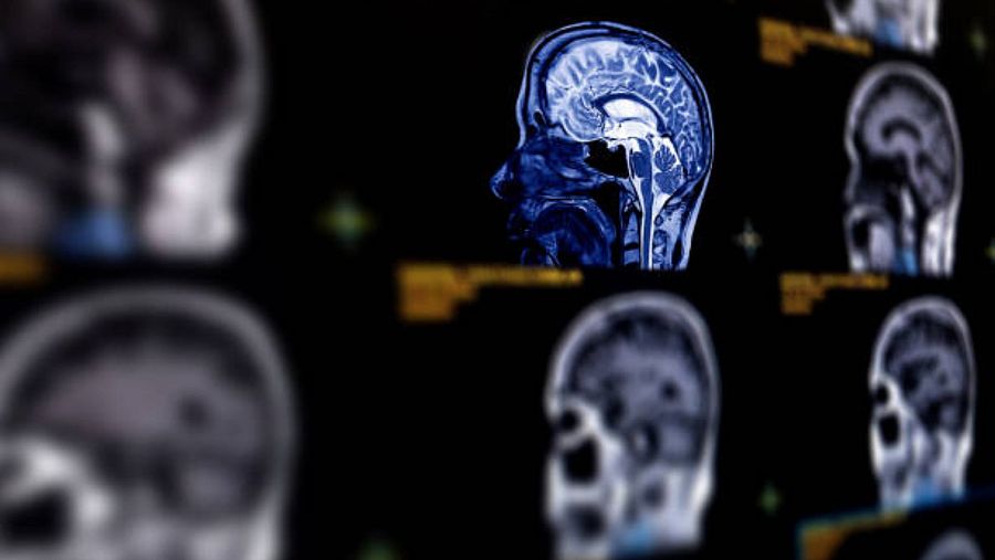 Escáner cerebral