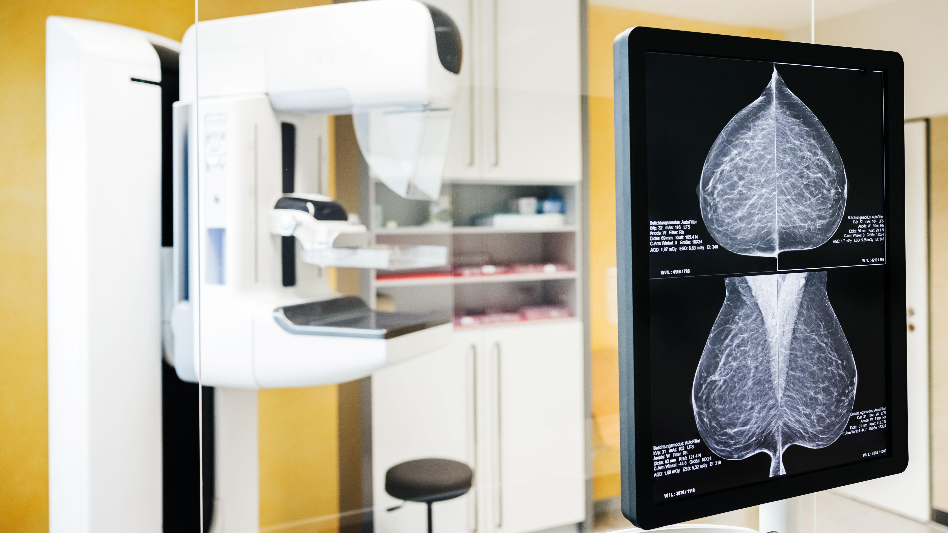 La Junta de Andalucía reconoce 2.000 mujeres con pruebas de cáncer de mama dudosas y contactará una a una