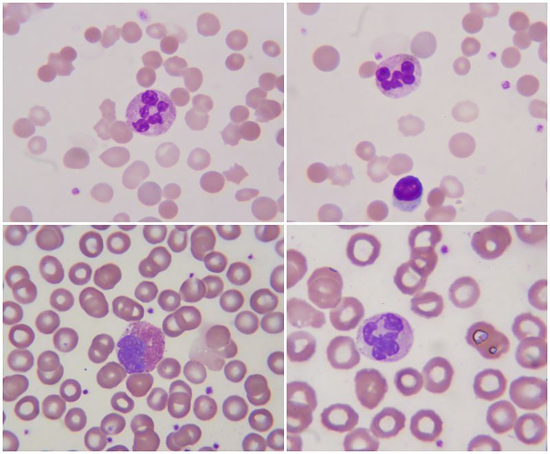 Crean nuevas recomendaciones para tratar la leucemia linfática crónica