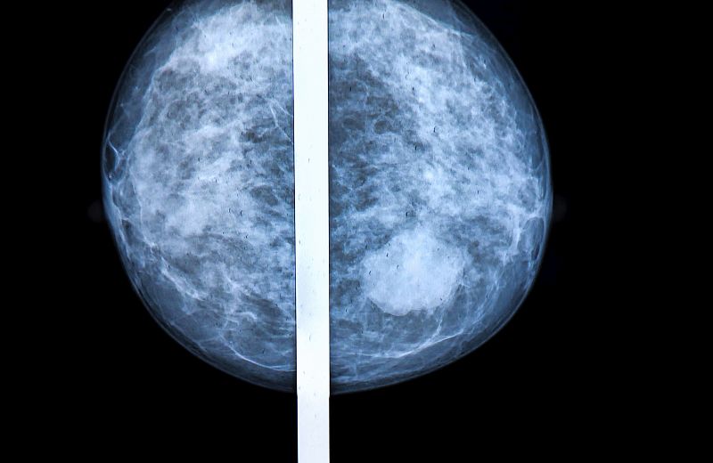 Describen cómo las células de cáncer de mama transforman células sanas en tumorales