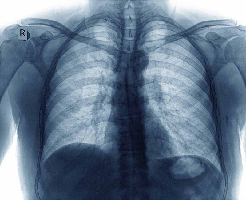 Avanzan en el conocimiento de unos genes que protegen del cáncer de pulmón