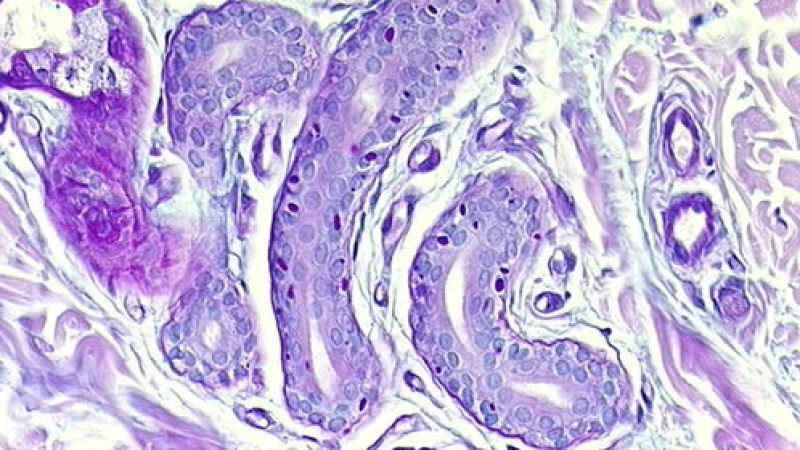 Enfermedad de Lafora, una forma rara de epilepsia