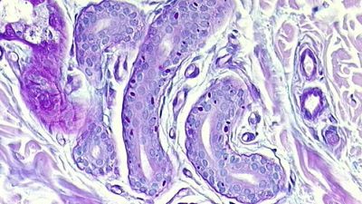 Entre probetas - Enfermedad de Lafora. Enfermedad epiléptica rara - Escuchar ahora