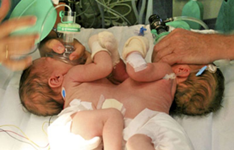 8 horas para separar a unas siamesas unidas por el abdomen en un hospital de Sevilla