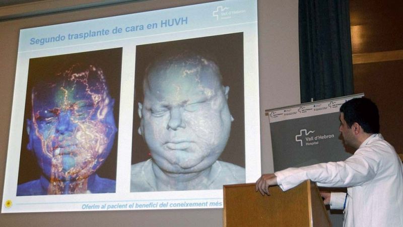 El hospital Vall d'Hebron realiza con éxito su segundo trasplante de cara