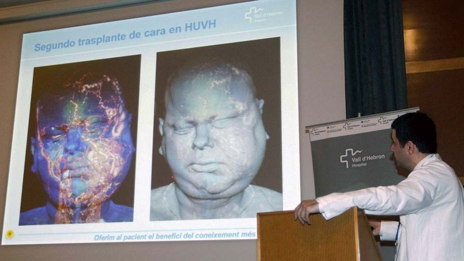 Éxito en el segundo trasplante de cara realizado en el Vall d'Hebron