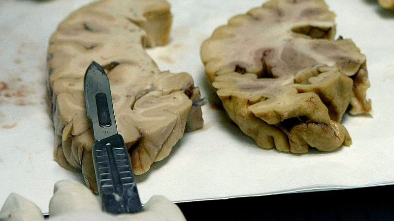 Una investigación apunta a que una proteína asociada al alzhéimer puede transmitirse en procedimientos médicos