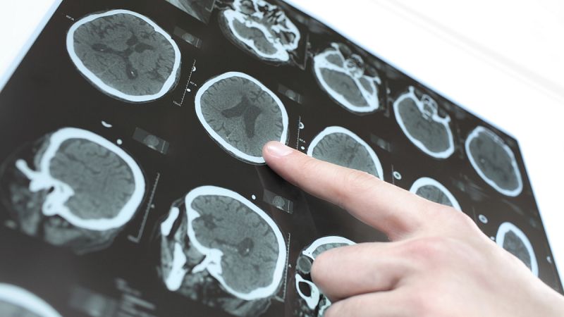El ictus afecta a 120.000 personas cada año en España y es la primera causa de incapacidad