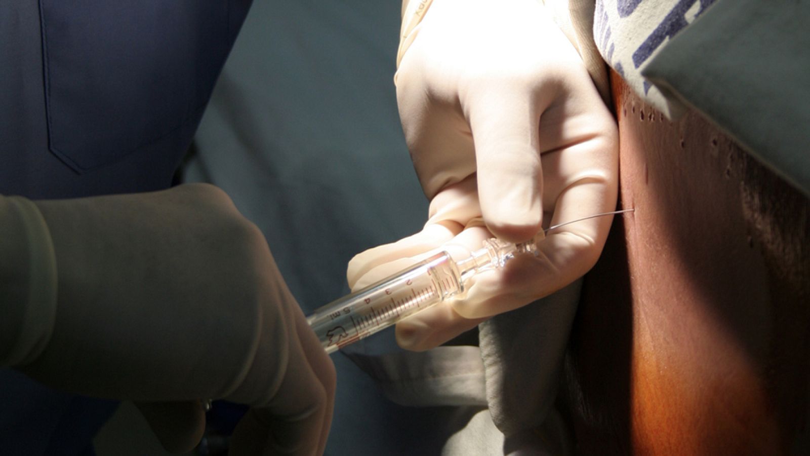 Científicos del Vall d'Hebron Instituto de Oncología (VHIO) han desarrollado la primera biopsia líquida del líquido cefalorraquídeo (LCR), que ha demostrado ser un instrumento eficiente para hacer un diagnóstico precoz, pronosticar, diseñar el plan t