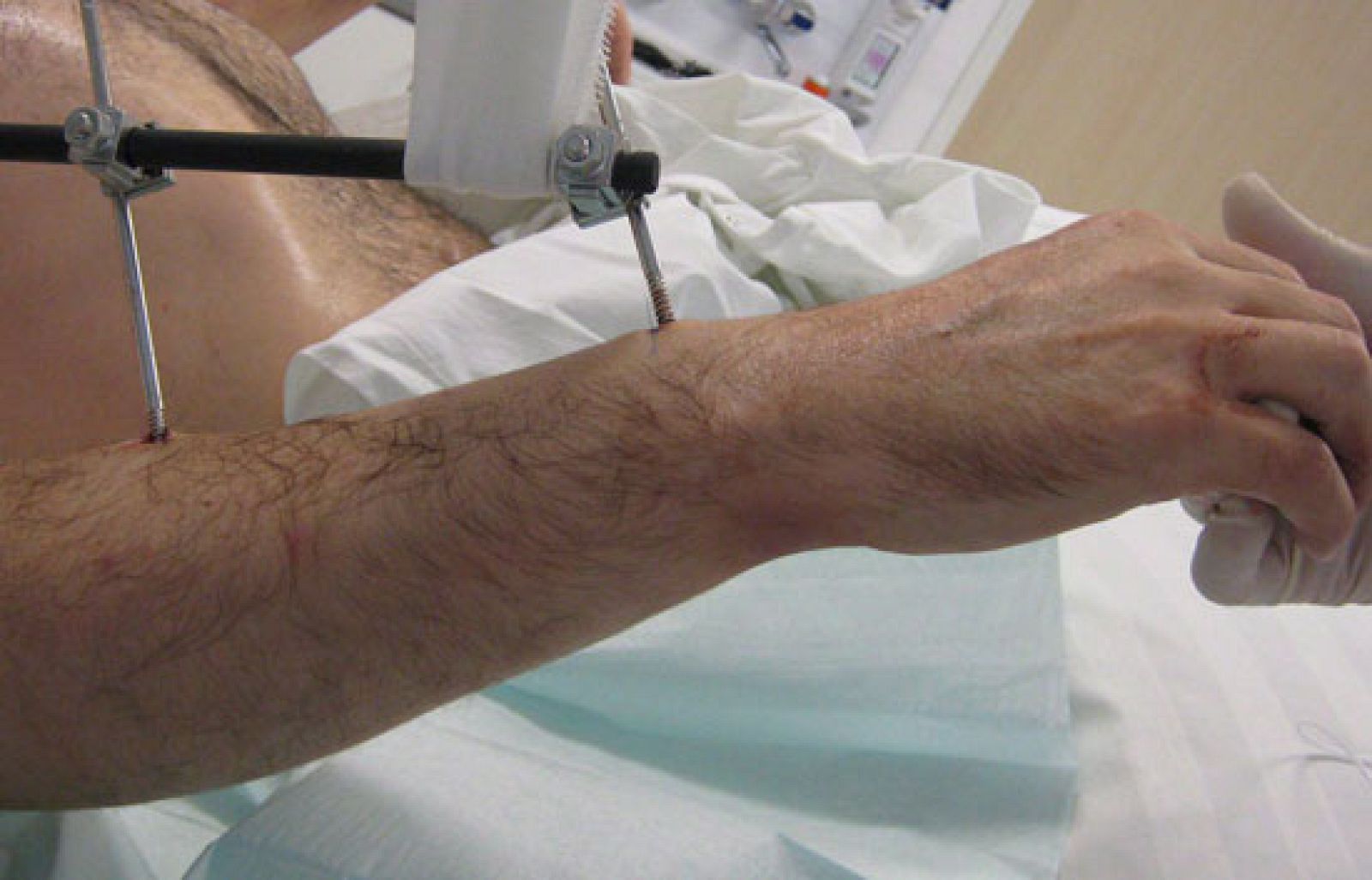 En la Universidad Técnica de Munich han logrado por primera vez reimplantar los brazos a un hombre. La operación duró 15 horas.