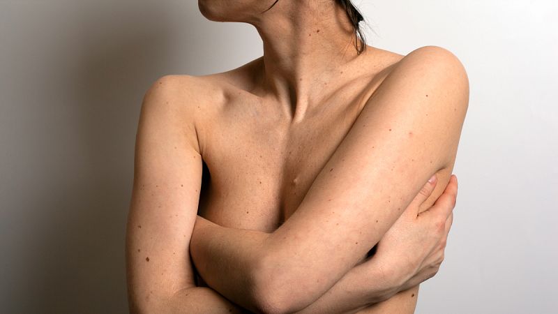 Un test genómico al diagnosticar el cáncer de mama predice cómo irá el tratamiento