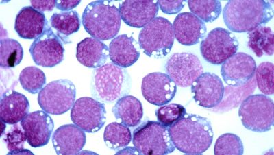 El laboratorio de JAL - Herpes y esclerosis múltiple - 22/02/16 - escuchar ahora