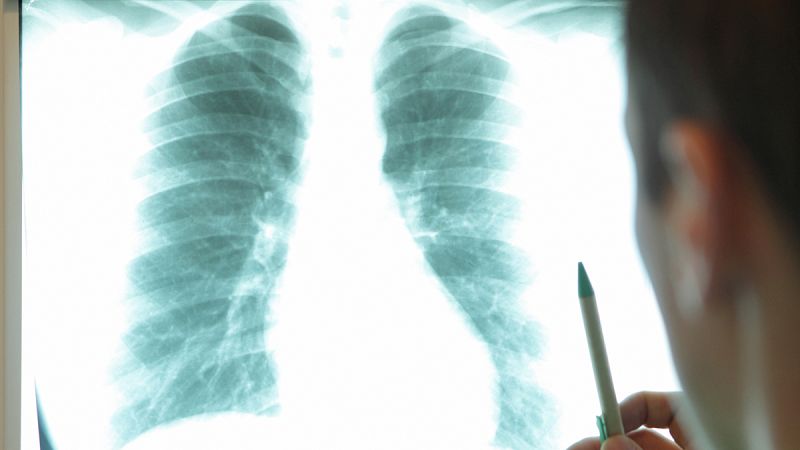 España contará con un registro de cáncer de pulmón