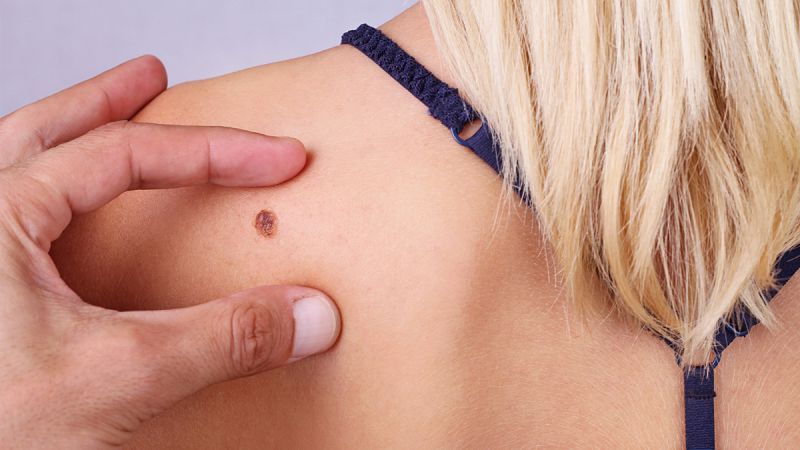 La supervivencia del melanoma supera el 90% después de cinco años gracias a los nuevos tratamientos