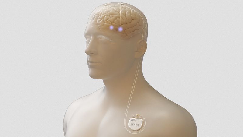 Presentan un sistema de estimulación cerebral profundo para pacientes con párkinson