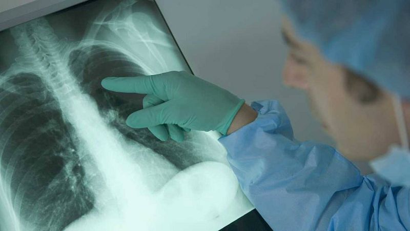 Hallan compuestos para atacar células madre tumorales del cáncer de pulmón