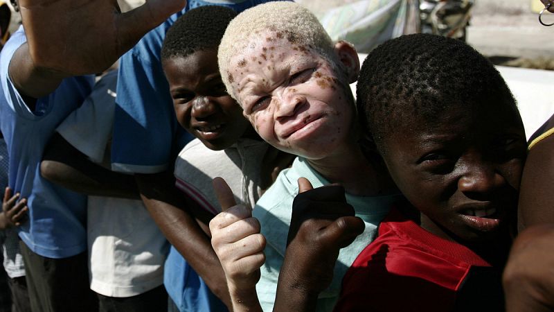 Albinismo, una enfermedad más allá del aspecto singular