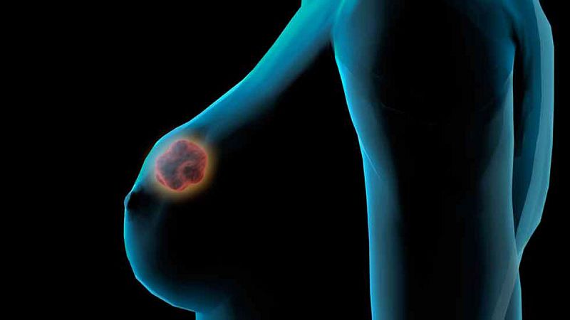 Las células del cáncer de mama se pueden 'silenciar', según investigadores españoles