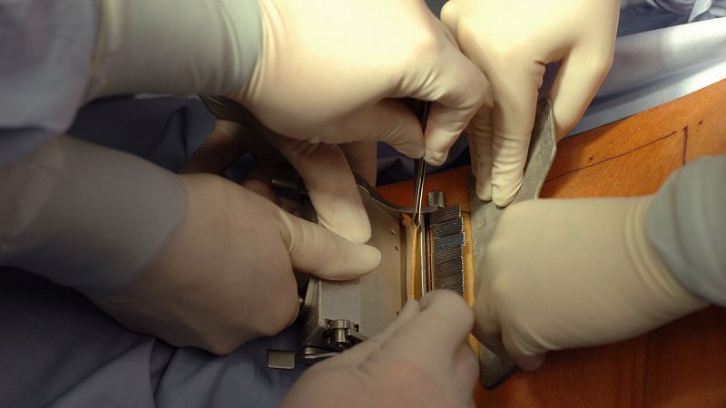 Andalucía realiza el primer trasplante en España de piel fabricada con células de la propia paciente